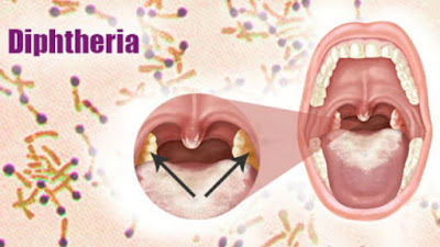 diphtheria640